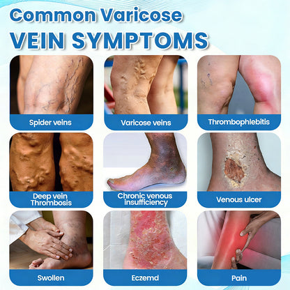 🇦🇺✅GFOUK® VascuCare Vein Healing Spray(Designed for Varicose veins, Spider veins, Deep vein Thrombosis, Chronic venous insufficiency, Venous ulcers, Thrombophlebitis and other venous issues)