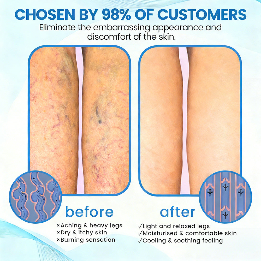 🇦🇺💃🌿GFOUK® VascuCare Vein Healing Spray(Designed for Varicose veins, Spider veins, Deep vein Thrombosis, Chronic venous insufficiency, Venous ulcers, Thrombophlebitis and other venous issues)
