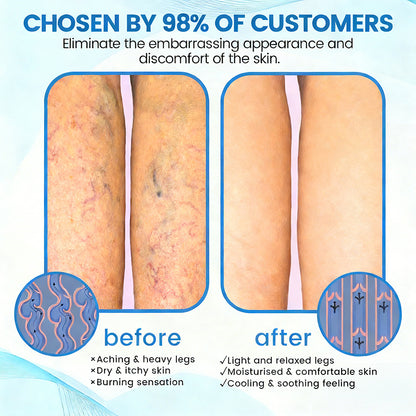 🇦🇺💃🌿GFOUK® VascuCare Vein Healing Spray(Designed for Varicose veins, Spider veins, Deep vein Thrombosis, Chronic venous insufficiency, Venous ulcers, Thrombophlebitis and other venous issues)