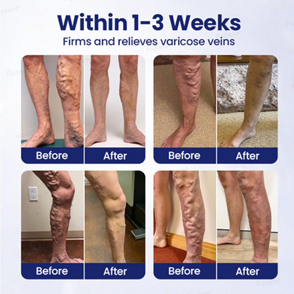 🏆Made and Shipped from Australia🌿Furzero® VeinFreedom Herbal Spray - MicroMist Therapy