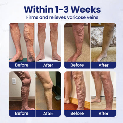 🏆Made and Shipped from Australia🌿Furzero® VeinFreedom Herbal Spray - MicroMist Therapy