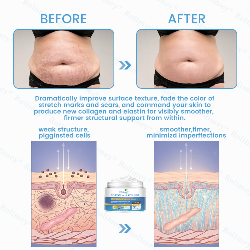 🇦🇺🎁Rolimey® Botox + Retinol Skin Firming & Lifting Cream⏰For Aging issues