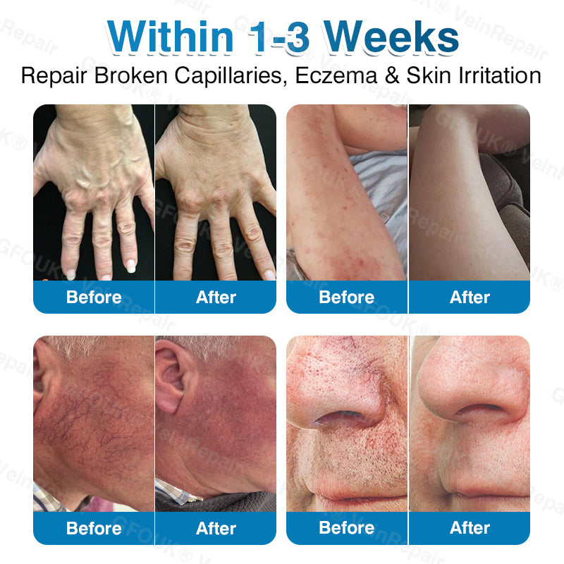 🇦🇺✅👨‍⚕️🫶GFOUK® VeinRepair Microneedle Patch Roll⚡Instant Relief, Long-Term Results