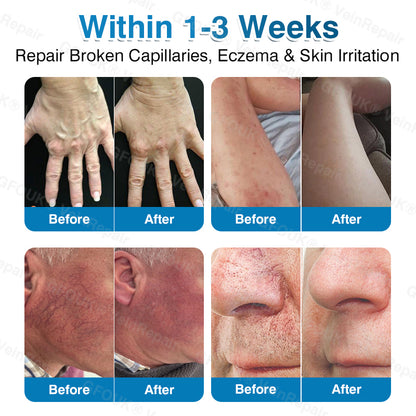 🇦🇺✅👨‍⚕️🫶GFOUK® VeinRepair Microneedle Patch Roll⚡Instant Relief, Long-Term Results