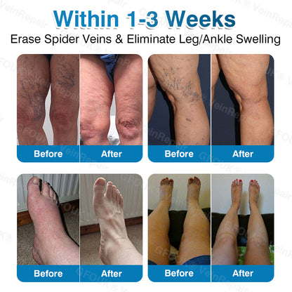 🇦🇺✅👨‍⚕️🫶GFOUK® VeinRepair Microneedle Patch Roll⚡Instant Relief, Long-Term Results