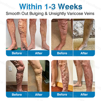 🇦🇺✅👨‍⚕️🫶GFOUK® VeinRepair Microneedle Patch Roll⚡Instant Relief, Long-Term Results