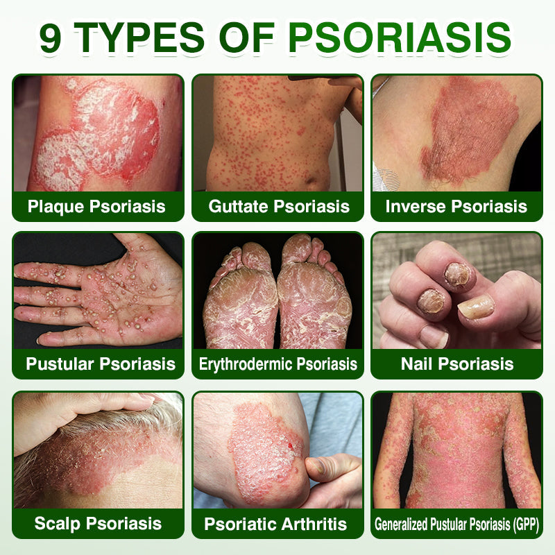 🇦🇺🏅🛡️✅DOCTIA® SkinRecovery Reishi Psoriasis Repair Spray