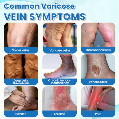 🇦🇺✅Ourlyard® VascuCare Vein Healing Spray(Designed for Varicose veins, Spider veins, Deep vein Thrombosis, Chronic venous insufficiency, Venous ulcers, Thrombophlebitis and other venous issues)