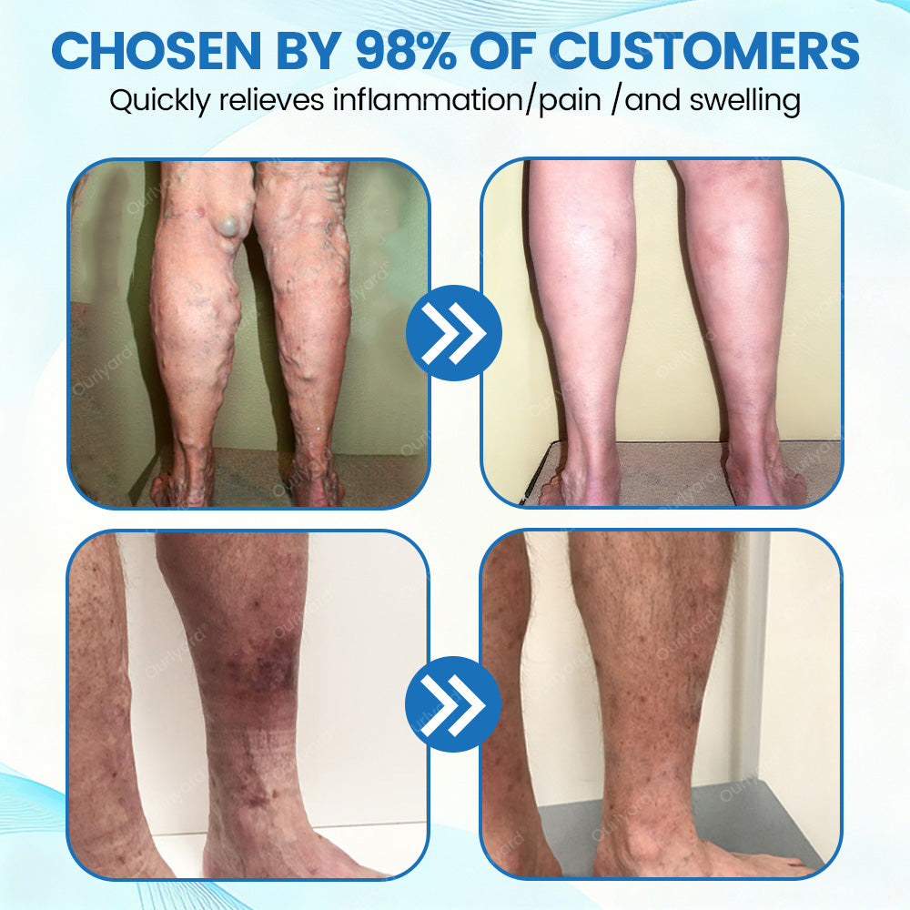 🇦🇺✅Ourlyard® VascuCare Vein Healing Spray(Designed for Varicose veins, Spider veins, Deep vein Thrombosis, Chronic venous insufficiency, Venous ulcers, Thrombophlebitis and other venous issues)