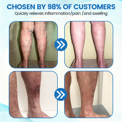 🇦🇺✅Ourlyard® VascuCare Vein Healing Spray(Designed for Varicose veins, Spider veins, Deep vein Thrombosis, Chronic venous insufficiency, Venous ulcers, Thrombophlebitis and other venous issues)