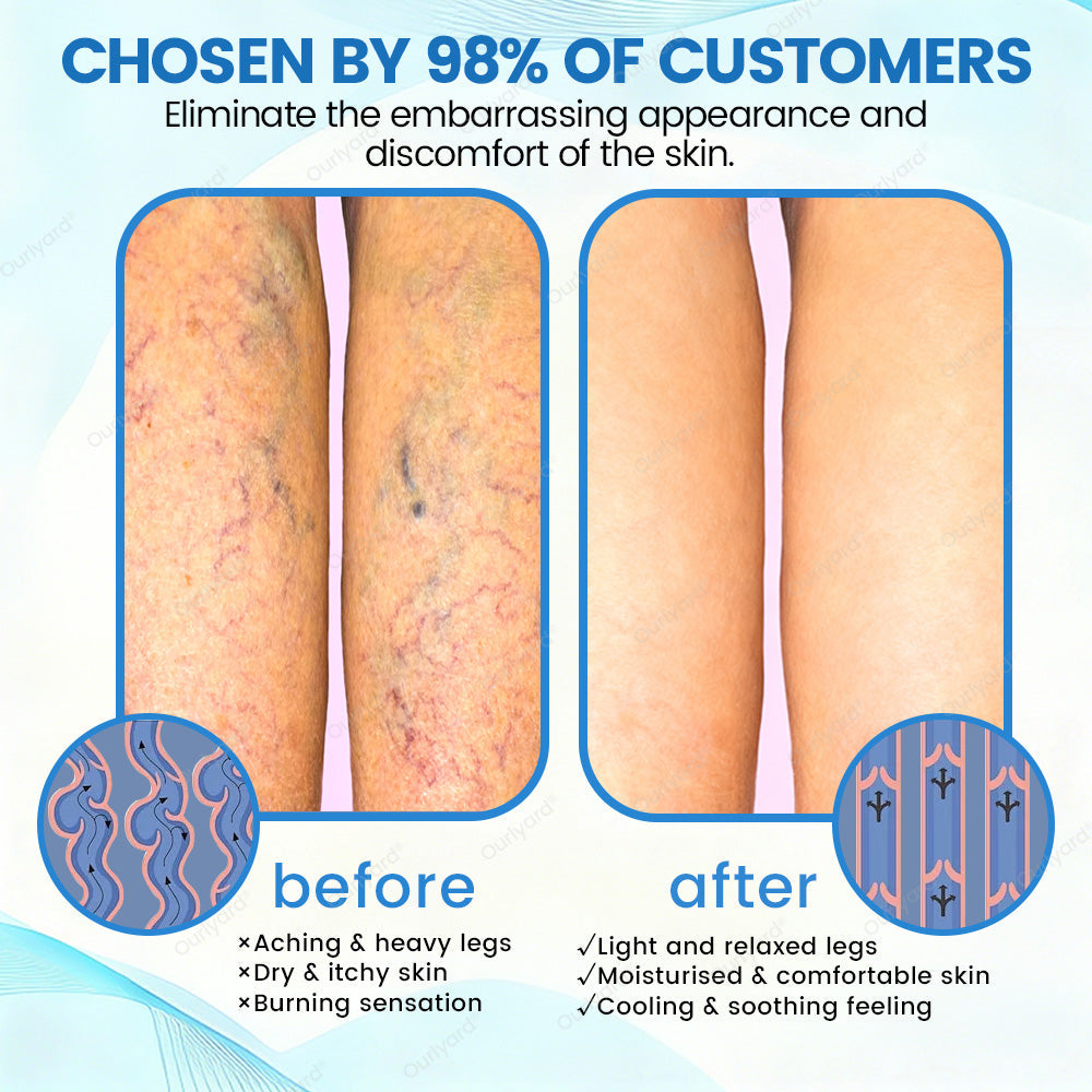 🇦🇺✅Ourlyard® VascuCare Vein Healing Spray(Designed for Varicose veins, Spider veins, Deep vein Thrombosis, Chronic venous insufficiency, Venous ulcers, Thrombophlebitis and other venous issues)
