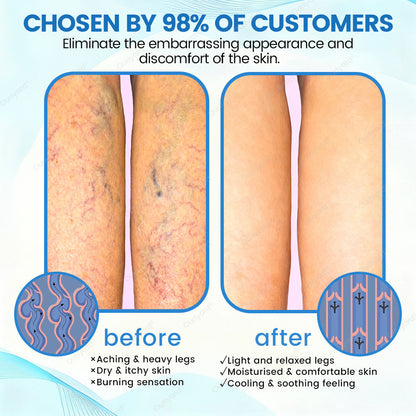 🇦🇺✅Ourlyard® VascuCare Vein Healing Spray(Designed for Varicose veins, Spider veins, Deep vein Thrombosis, Chronic venous insufficiency, Venous ulcers, Thrombophlebitis and other venous issues)